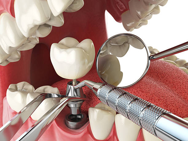 Best Emergency Treatment for Toothache in Cao, ND